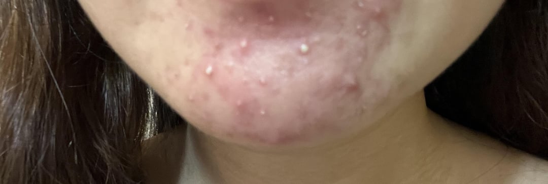 [Acne] Recurring whiteheads and redness on chin, wwyd?
